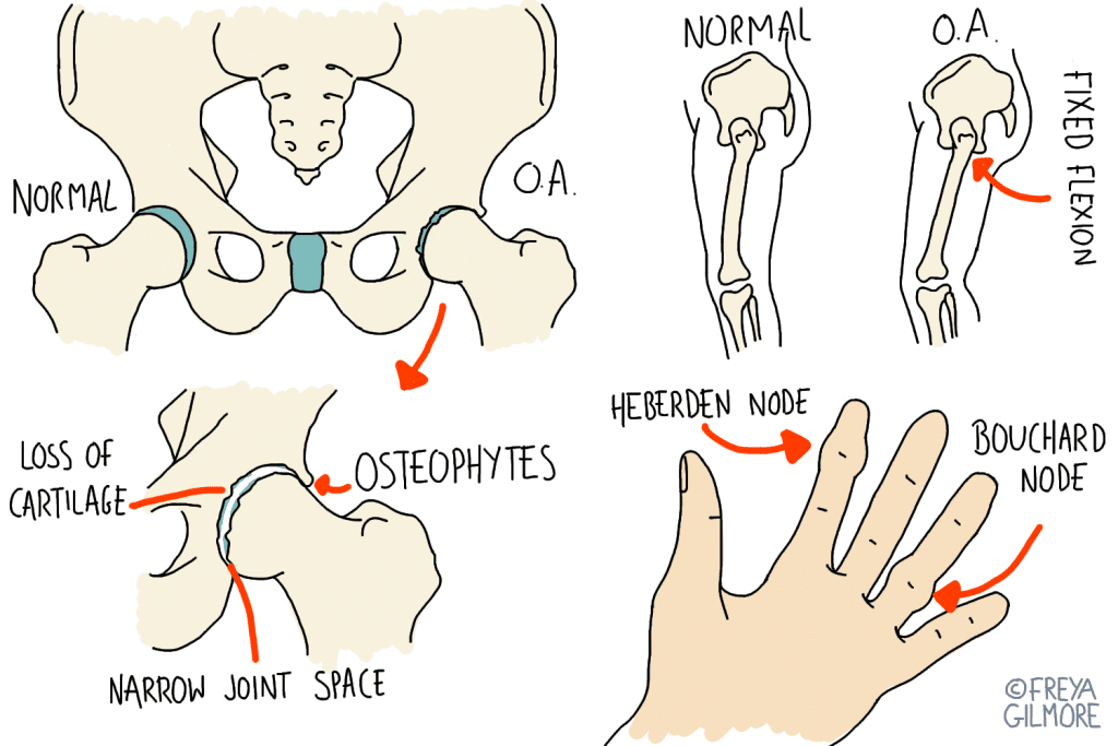 Arthritis in the hips and hands