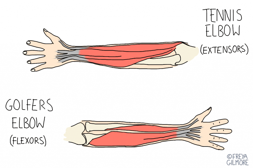 Tennis elbow and golfers elbow: the muscles involved